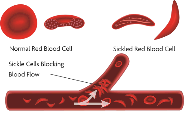 Sickle Cell Disease | Sickle Cell Association